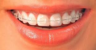 Kodėl daugelis renkasi tiesinti dantis breketais?